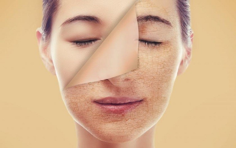  Làn da khô sạm là biểu hiện của tình trạng nội tiết kém